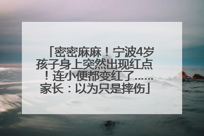 密密麻麻！宁波4岁孩子身上突然出现红点！连小便都变红了……家长：以为只是摔伤